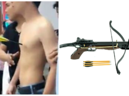 Un Chinois survit miraculeusement d'une flèche dans la poitrine