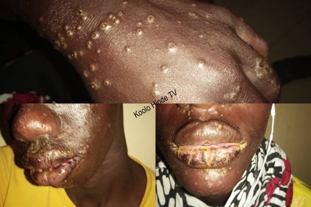 Une maladie rare de la peau touche des pêcheurs sénégalais